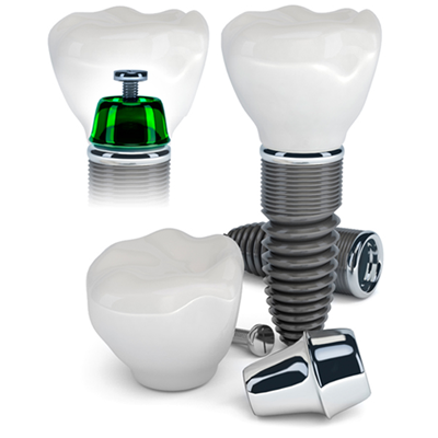 Nên lựa chọn trụ Implant loại nào?