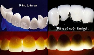 Có bao nhiêu loại răng sứ?