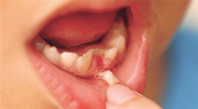 Hậu Quả Của Việc Mất Răng Sữa Sớm - Cha Mẹ Đừng Lơ Là