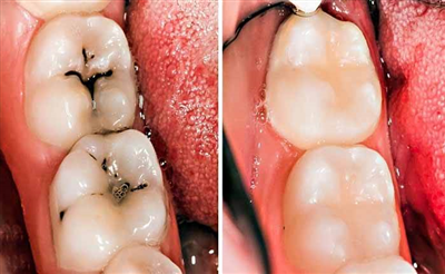 Bị sâu răng nên bọc răng sứ hay trám răng?
