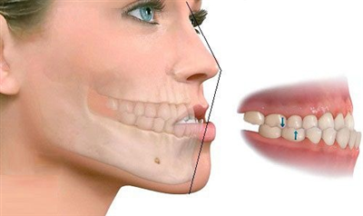 Khớp Cắn Ngược Là Gì? Nên Làm Gì Khi Bị Khớp Cắn Ngược?