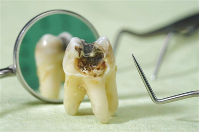 Sâu ngà răng là gì? Sâu ngà răng có chữa khỏi được không?