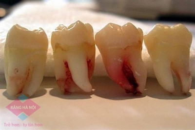 Răng khôn là răng nào? Một người có bao nhiêu răng khôn?