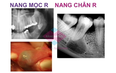 Nang chân răng có dễ phát hiện?