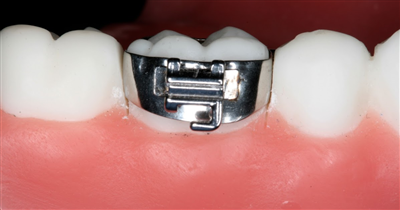Gắn band răng để làm gì?