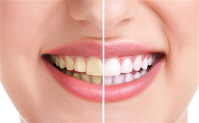 Bọc răng sứ rồi có tẩy trắng được không?