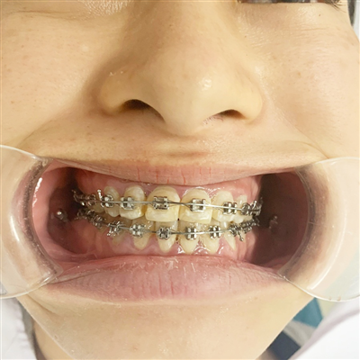 Niềng răng xong có bị hở lợi không?