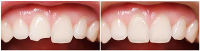 Răng sứ bị mẻ có trám lại được không?
