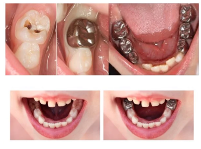 Chụp thép bảo vệ răng sữa cho trẻ em