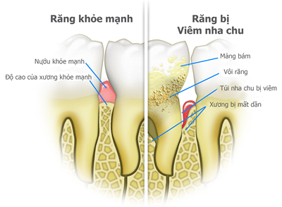Điều trị viêm nha chu
