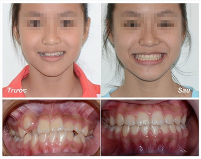 Niềng răng không chỉ cho bạn hàm răng đẹp