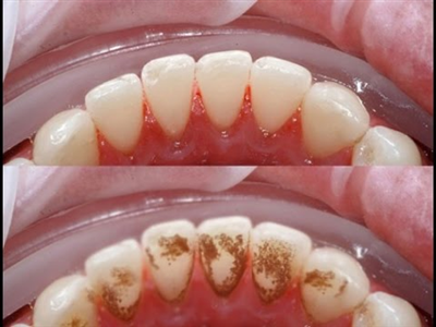 Lấy cao răng tại Răng Hà Nội