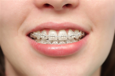 Niềng Răng Thất Bại Khi Nào Và Hậu Quả Ra Sao?