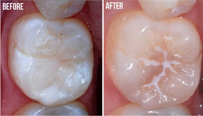 Trám bít hố rãnh dự phòng sâu răng