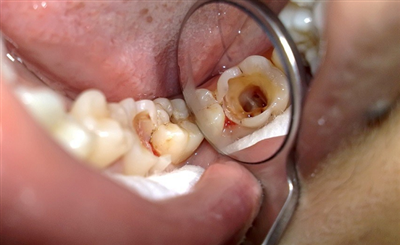 Triệu Chứng Sau Khi Lấy Tủy Răng: Bình Thường Và Bất Thường