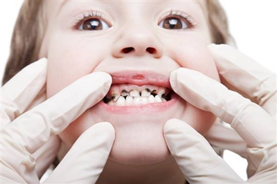 Sâu răng sữa: Một số điều cần biết