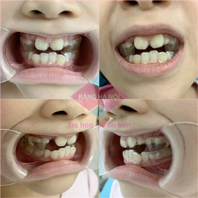 KHÍ CỤ CHỈNH NHA: TWIN BLOCK