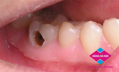 Điều trị răng bị thủng lỗ do sâu
