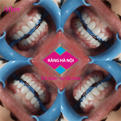 Bọc 16 răng sứ Lava Esthetic