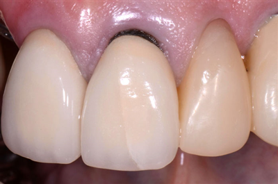 Chân răng bị đen: Nguyên nhân và cách điều trị