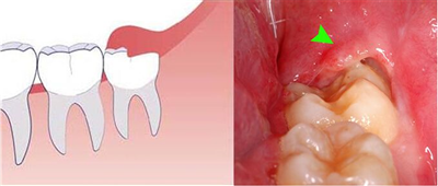 Phương Pháp Điều Trị Dứt Điểm Viêm Lợi Trùm