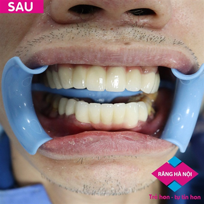 Phục hình răng sứ cho khách hàng răng yếu, mất nhiều răng