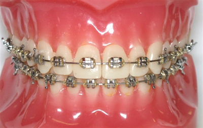 XỬ LÝ CÁC SỰ CỐ TẠI NHÀ KHI ĐANG NIỀNG RĂNG MẮC CÀI MÀ KHÔNG THỂ ĐẾN NHA KHOA TRONG MÙA DỊCH COVID